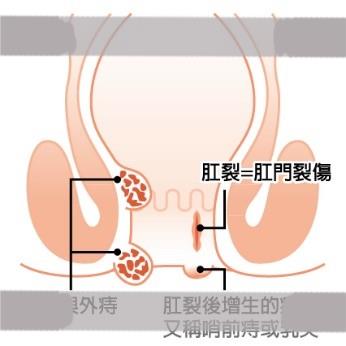 肛裂与痔疮