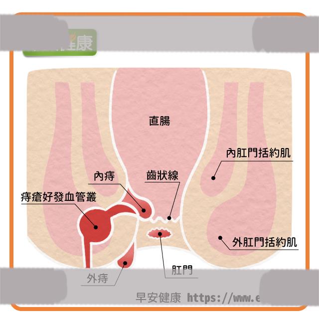 痔疮可分为内痔、外痔，依据发生位置是否在肛门齿状线以内而有不同。