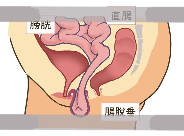 子宫切除后肠脱垂