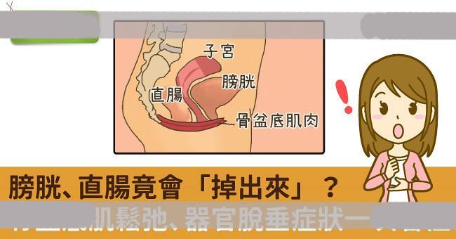 膀胱、直肠竟会「掉出来」？骨盆底肌松弛、器官脱垂症状一次看懂
